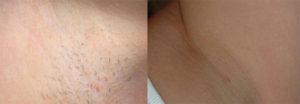 Simply Skin Oldham, Laser Hair Removal Clinic