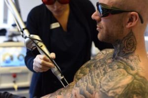 Laser Tattoo Removal at Simply Skin Oldham