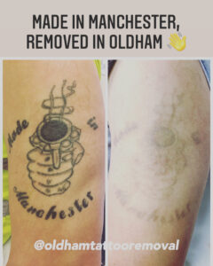 Oldham Tattoo Removal