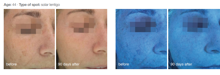Cosmelan Peel for pigmentation at Simply Skin Oldham, Manchester