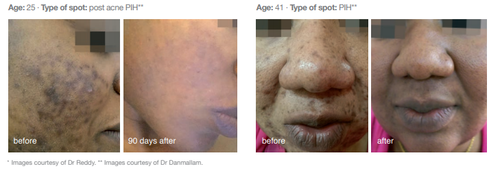 Cosmelan Peel for pigmentation at Simply Skin Oldham, Manchester